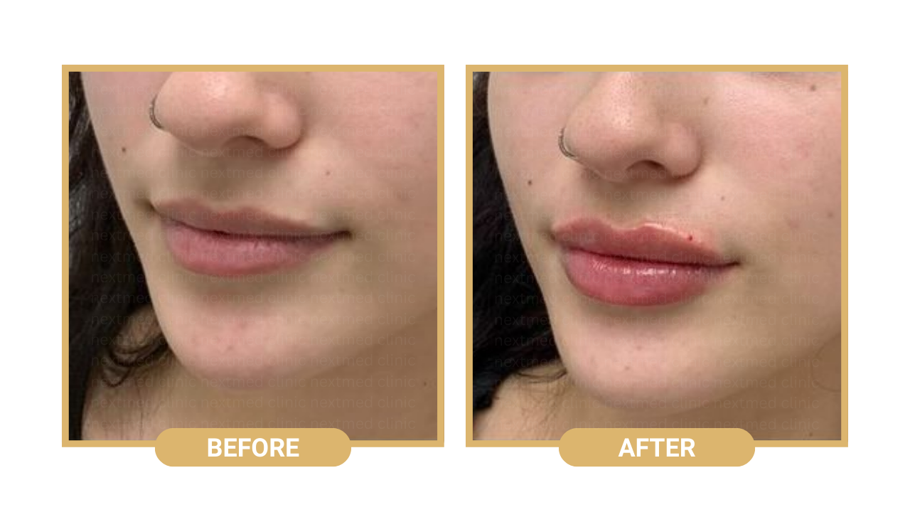 lip filler nextmed before after (6)