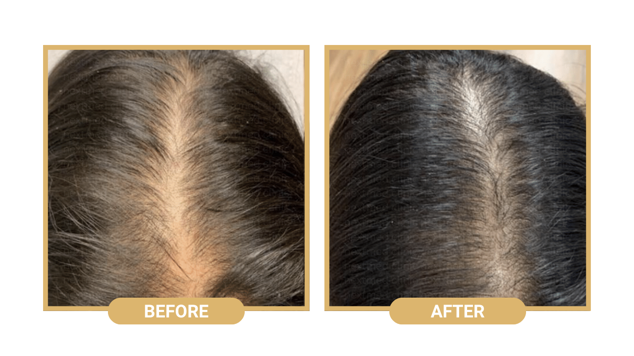 nextmed hair loss treatment (3)