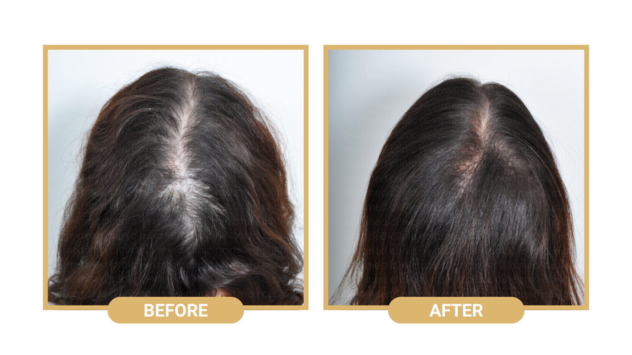 nextmed hair loss treatment (4)