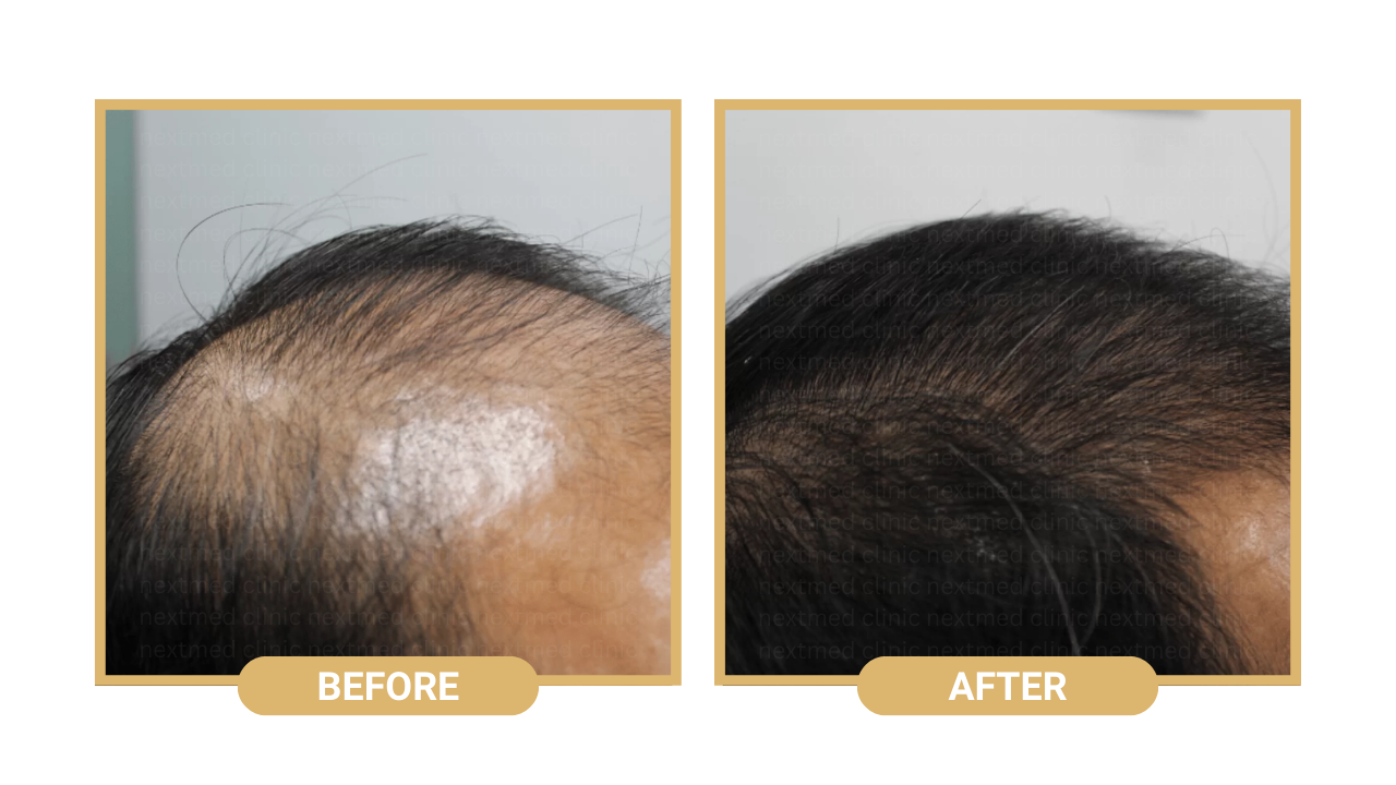 nextmed hair loss treatment (7)