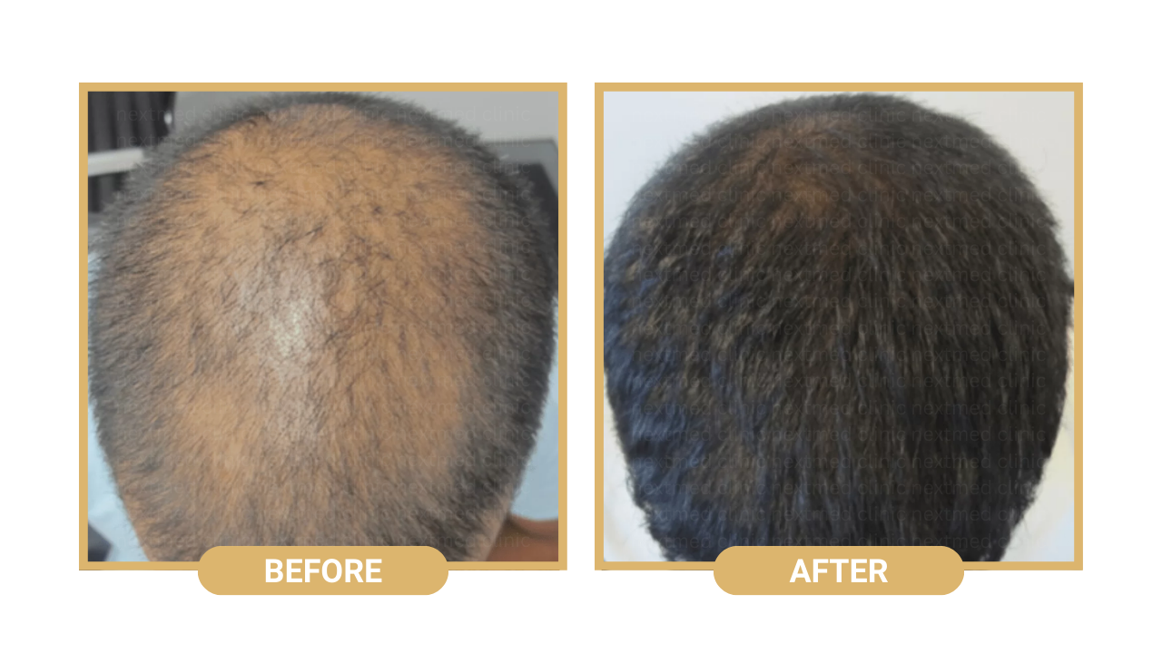 nextmed hair loss treatment (8)