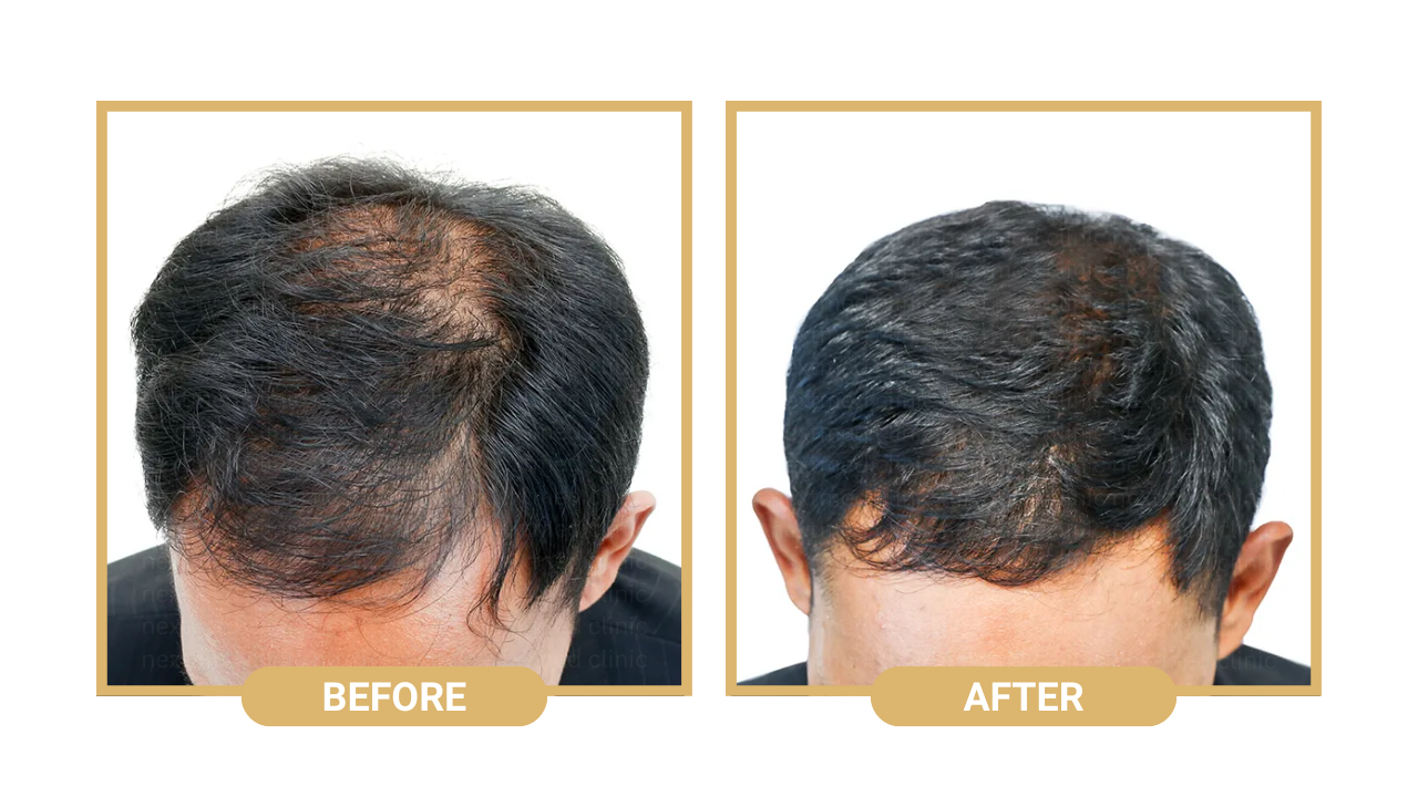 nextmed hair loss treatment (9)