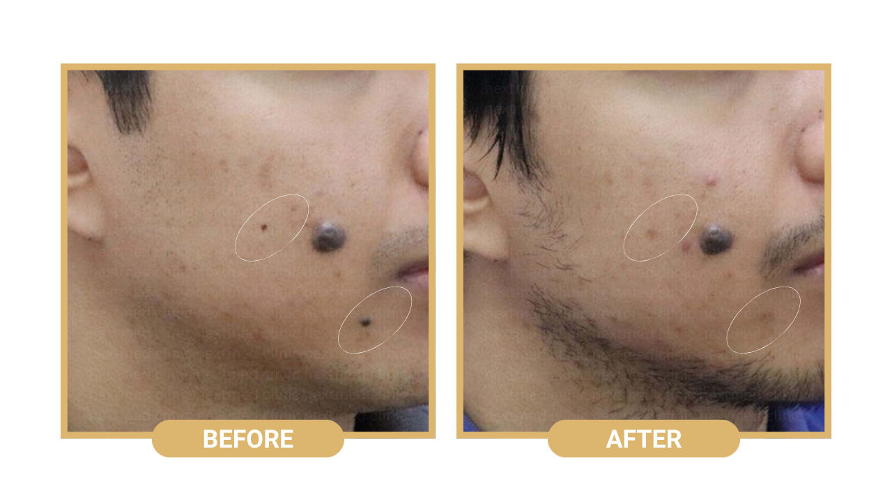 nm mole removal before after (1)