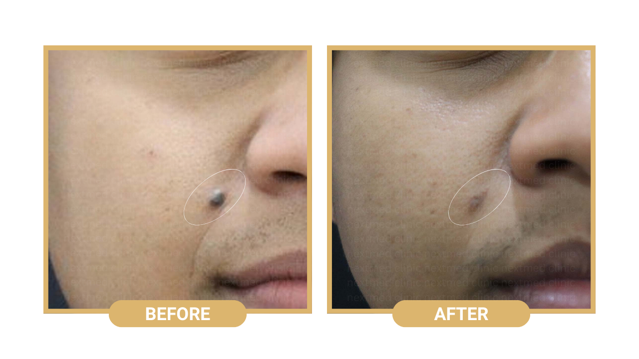 nm mole removal before after (3)