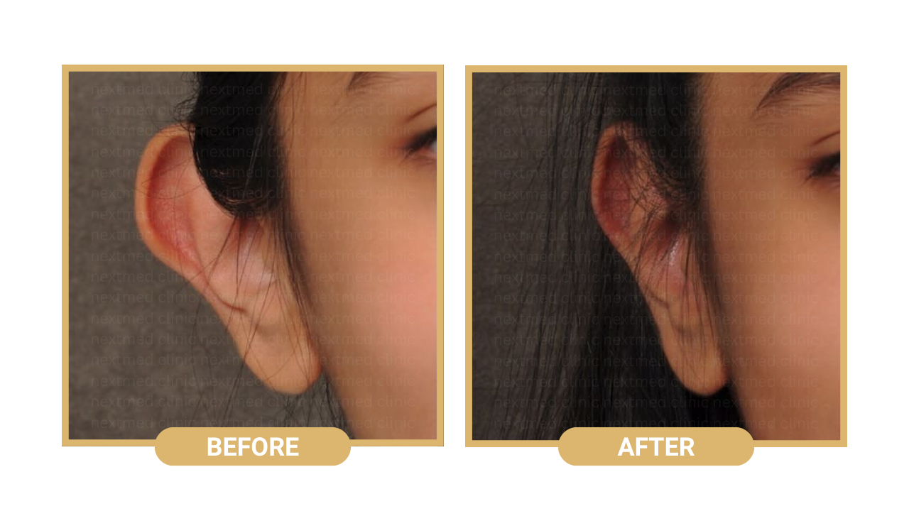 otoplasty