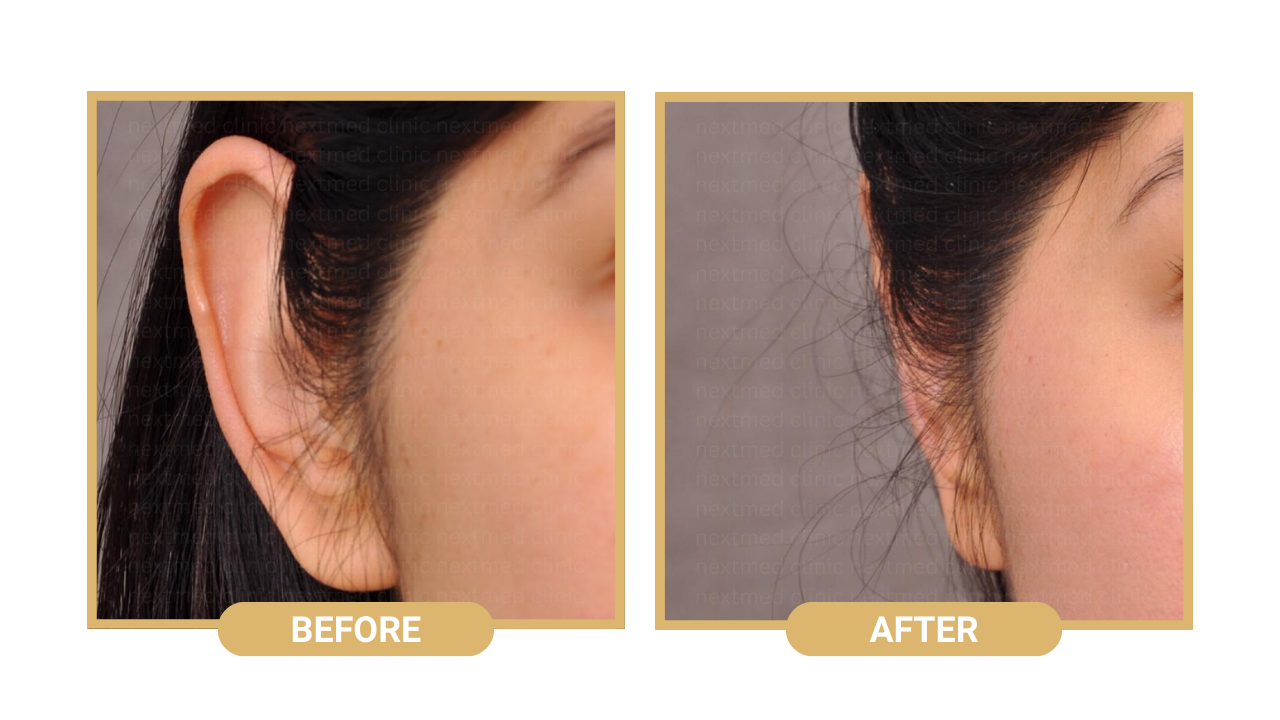 otoplasty