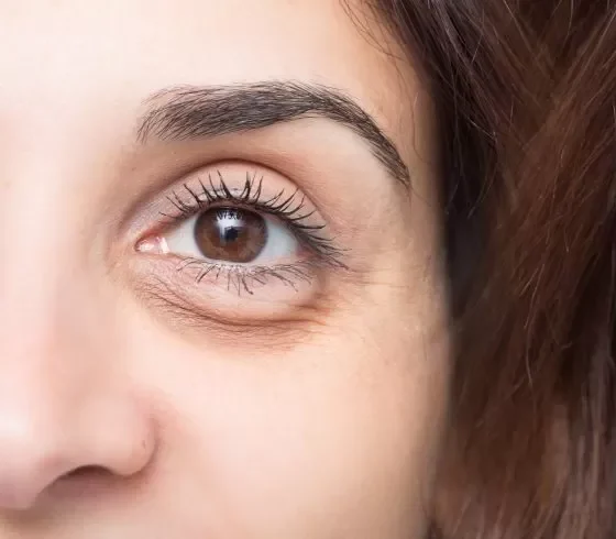 eyebag removal