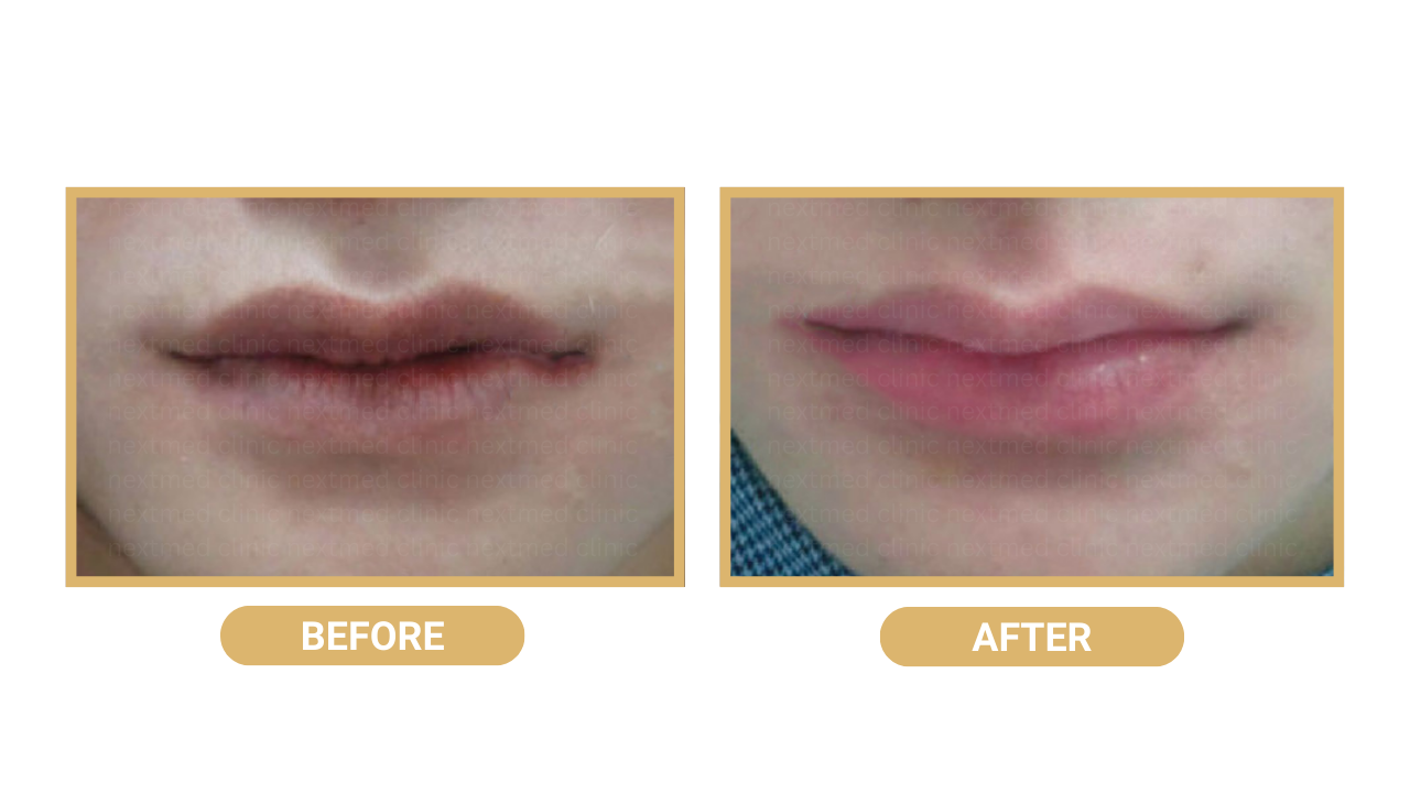 pink lips before after (3)