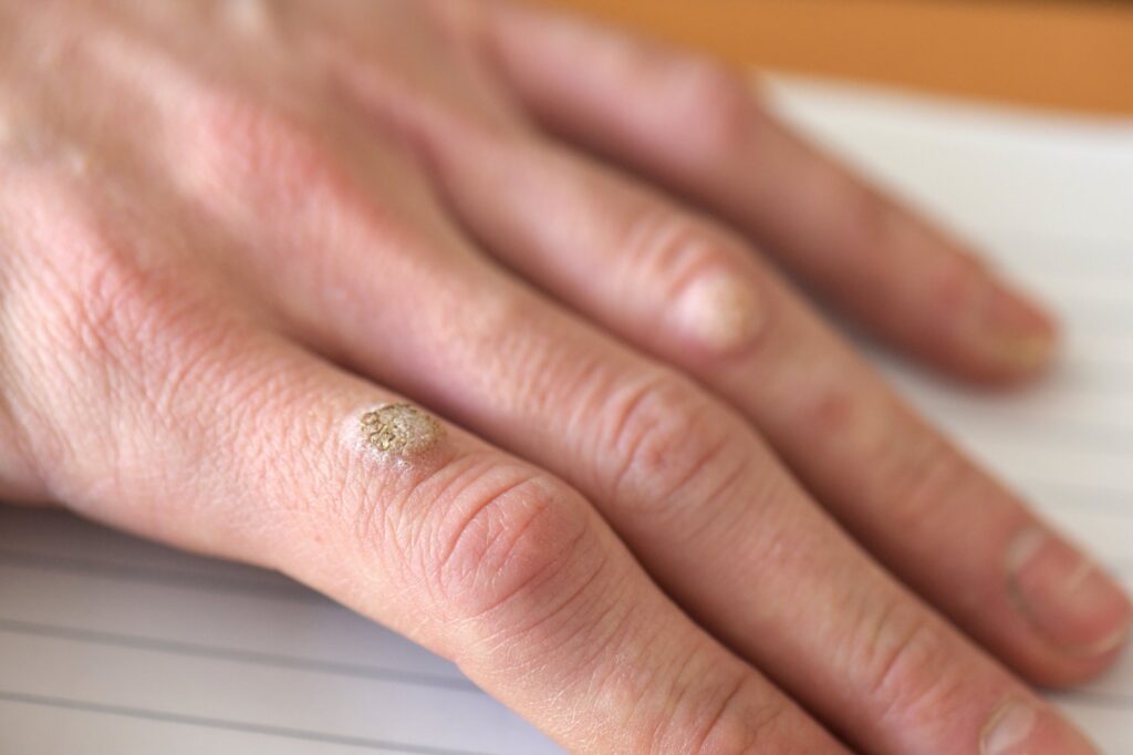 warts