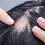 hair loss