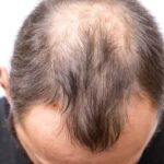 hair loss