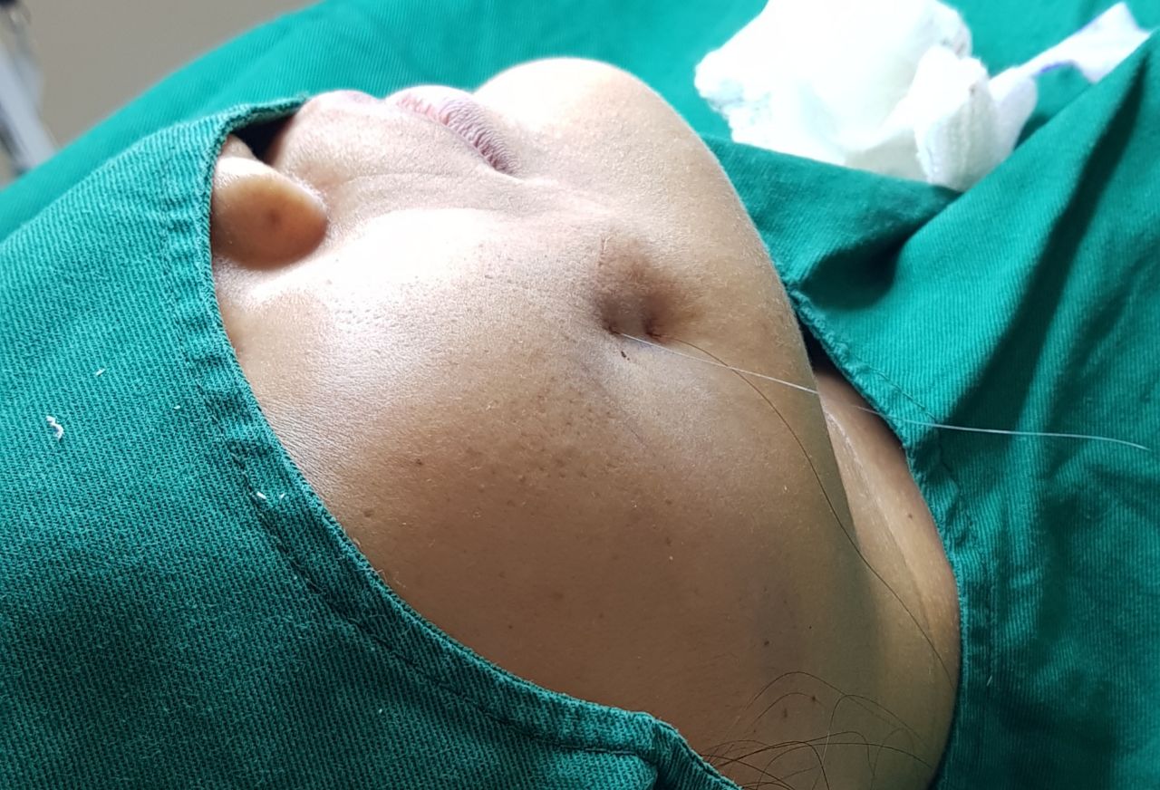 dimpleplasty