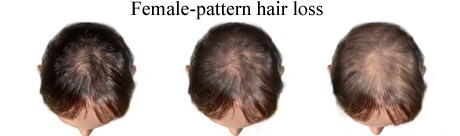 hair loss