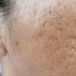 acne scar