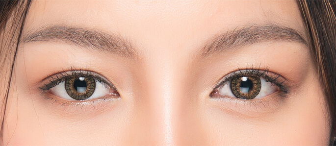 double-eyelid