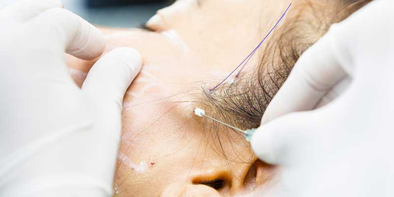face thread lift