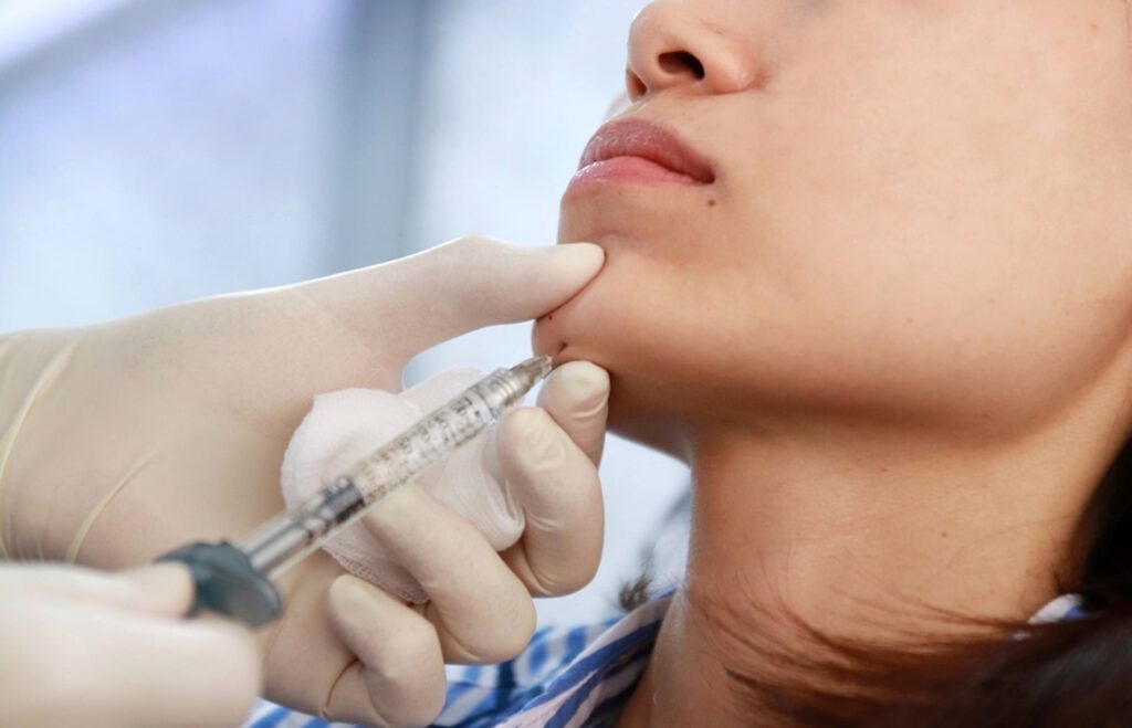 chin filler