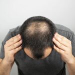 hair loss in Kuala Lumpur