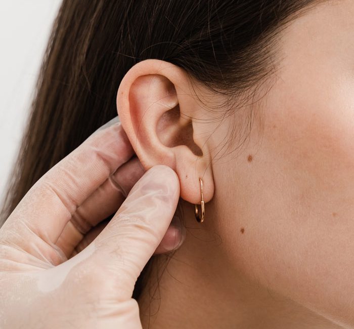 otoplasty