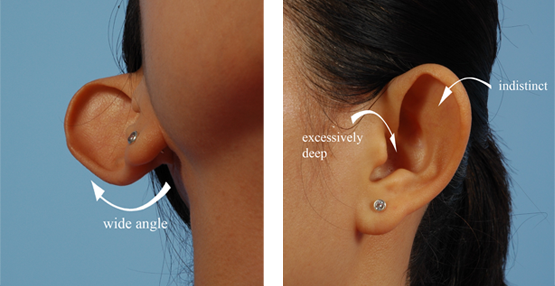 otoplasty