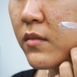 acne_cream