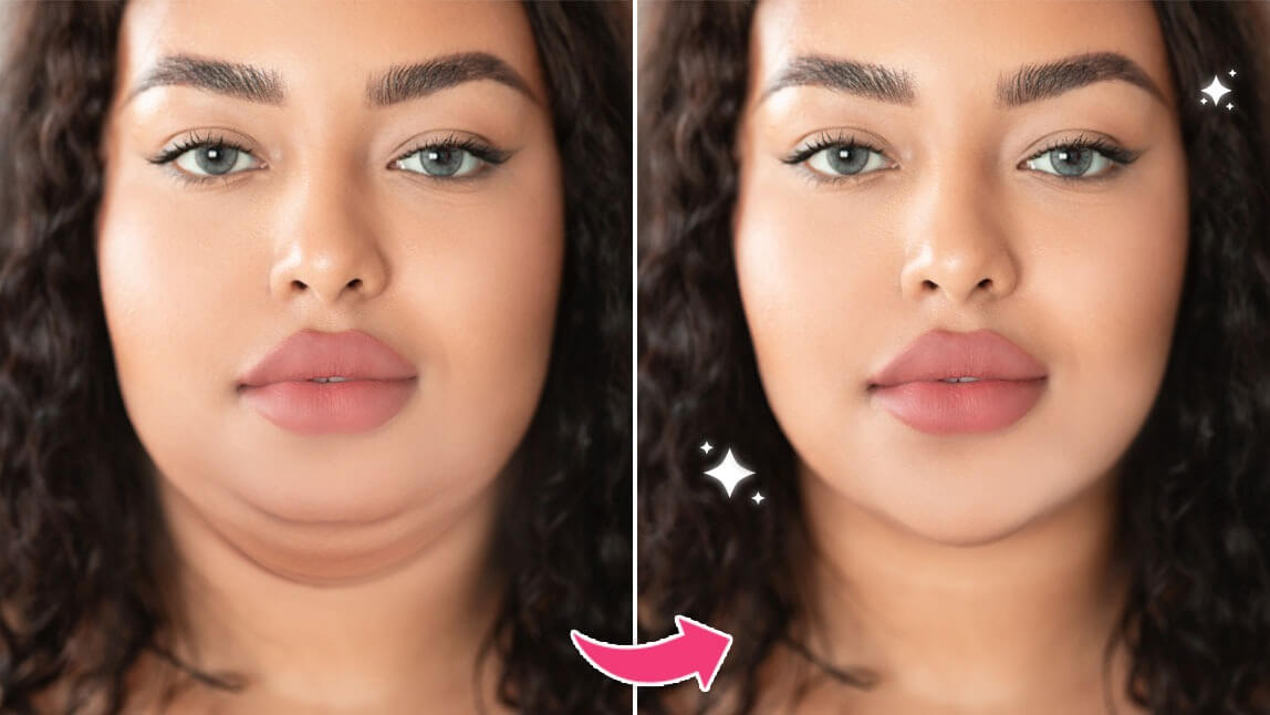 double chin removal
