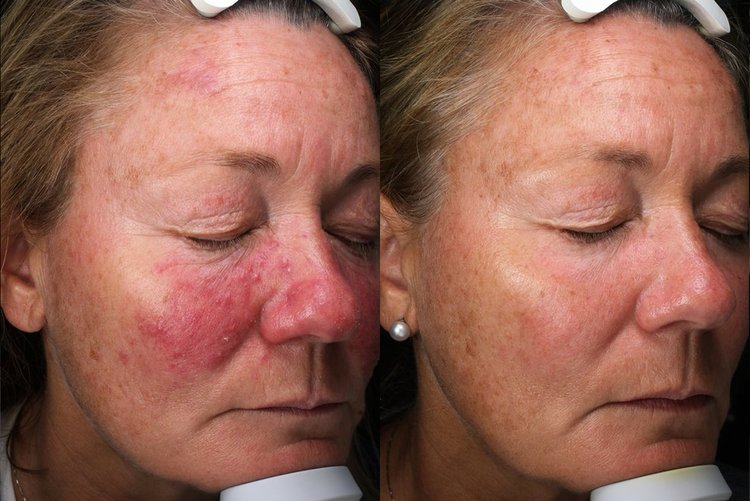 Rosacea+Before+After+3+copy