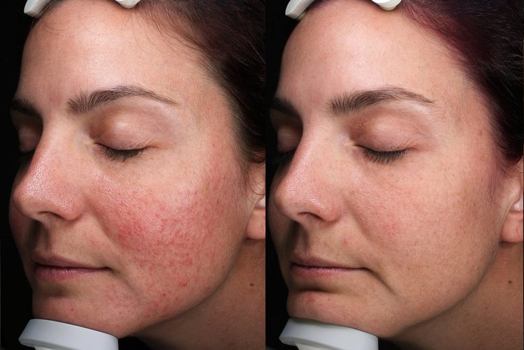Rosacea+Before+After+4+copy