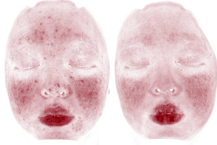 Rosacea+Before+After+5+copy