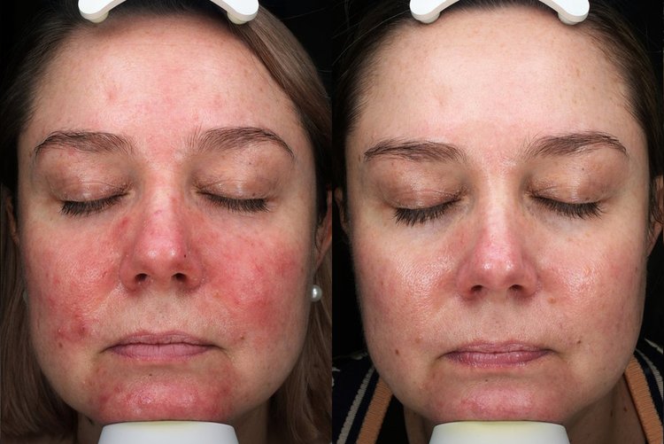 Rosacea+Before+After+front+copy