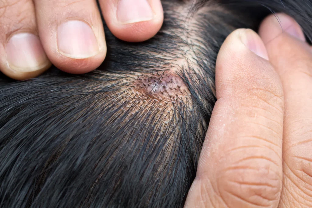 hair loss