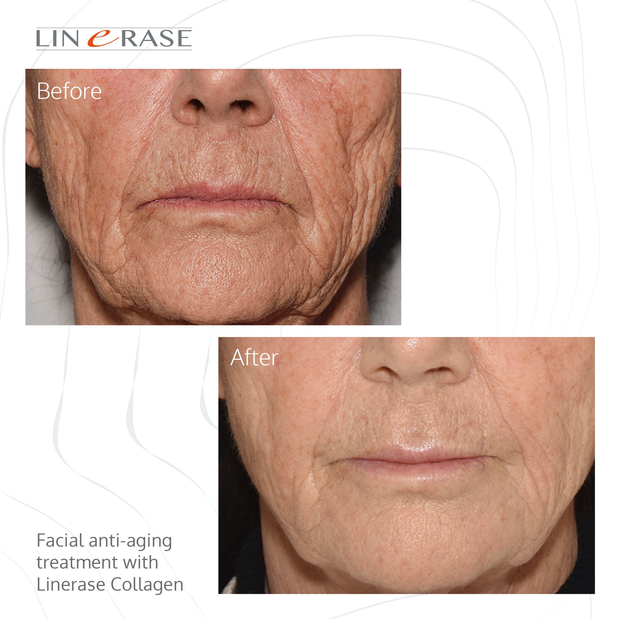 linerase