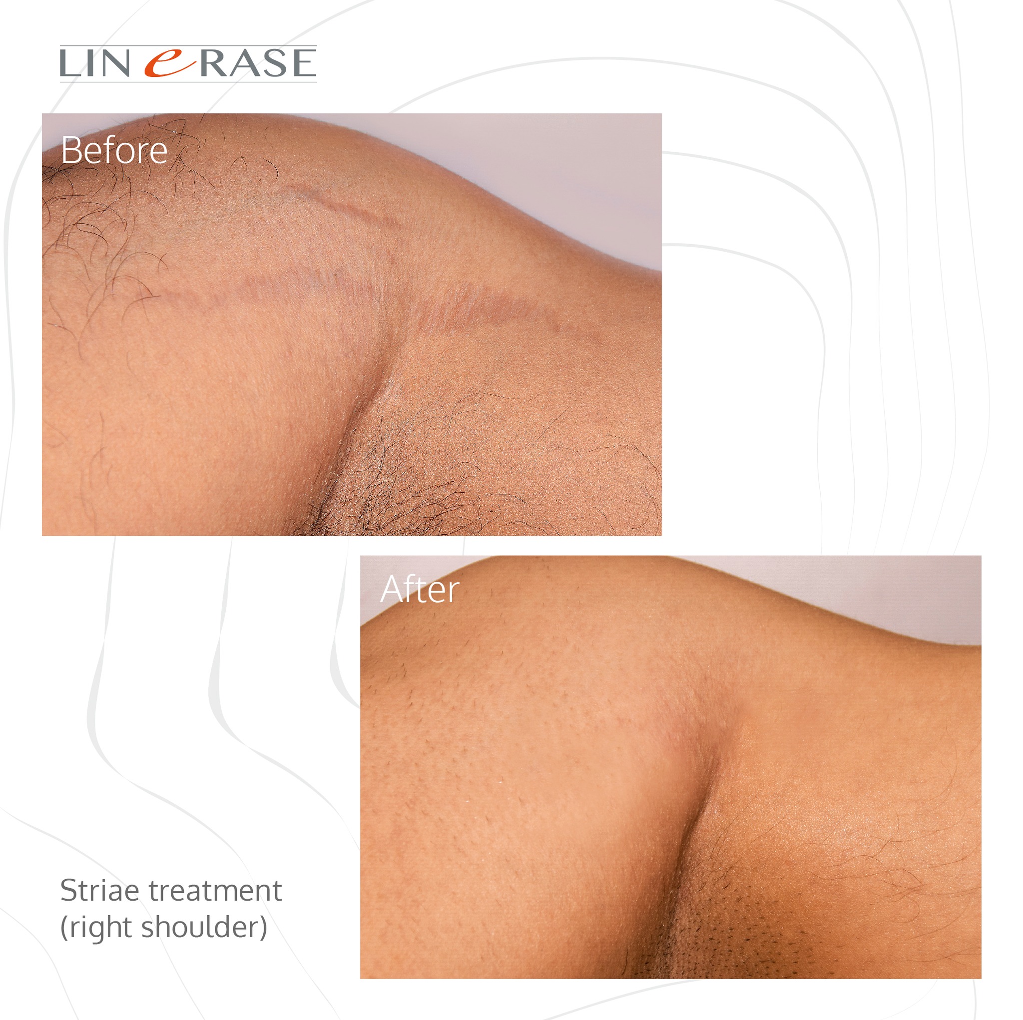 linerase