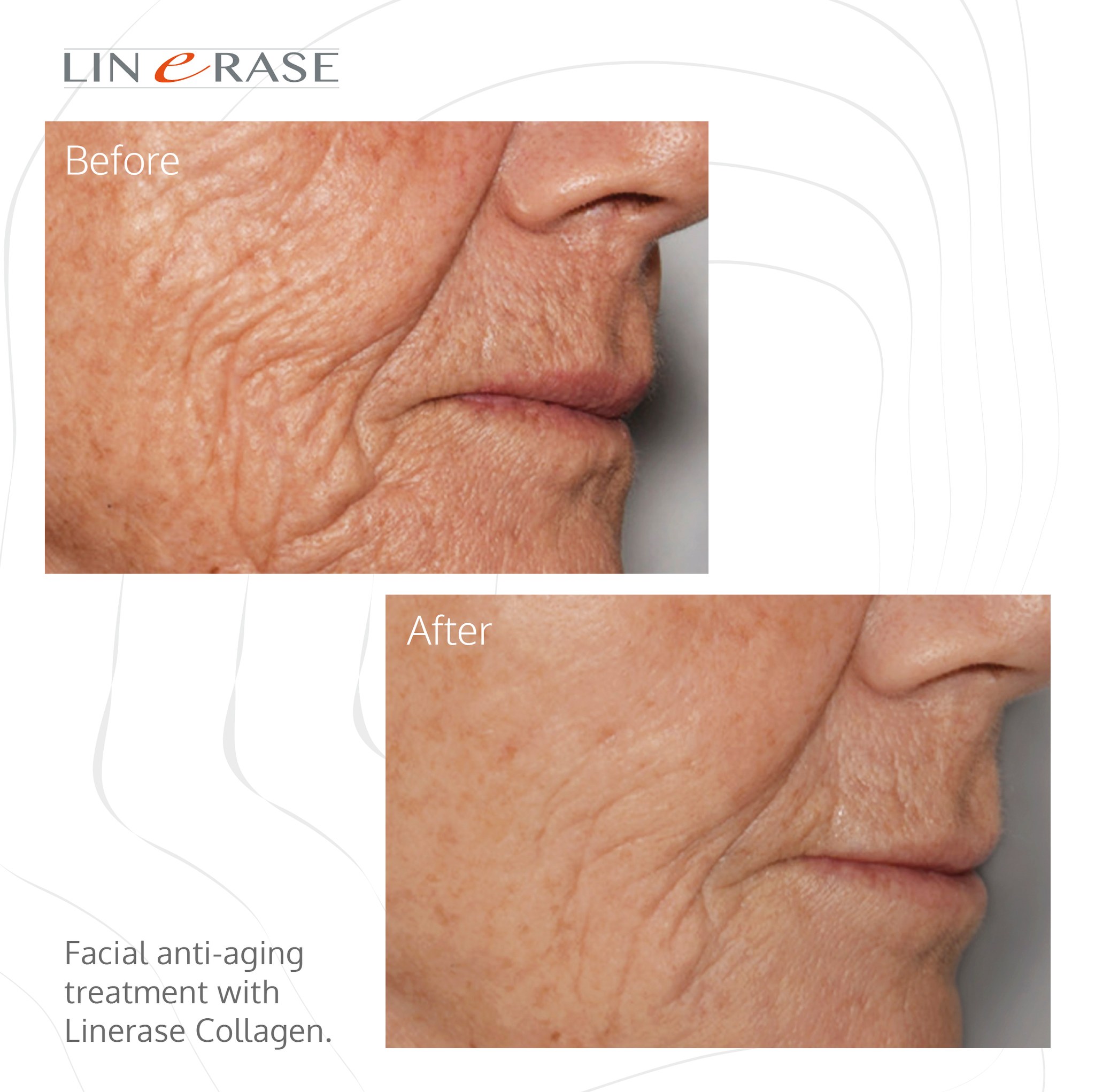 linerase