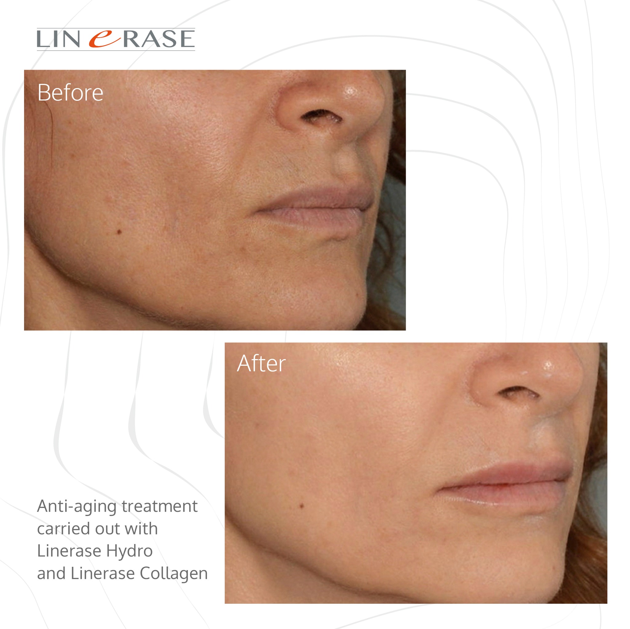 linerase
