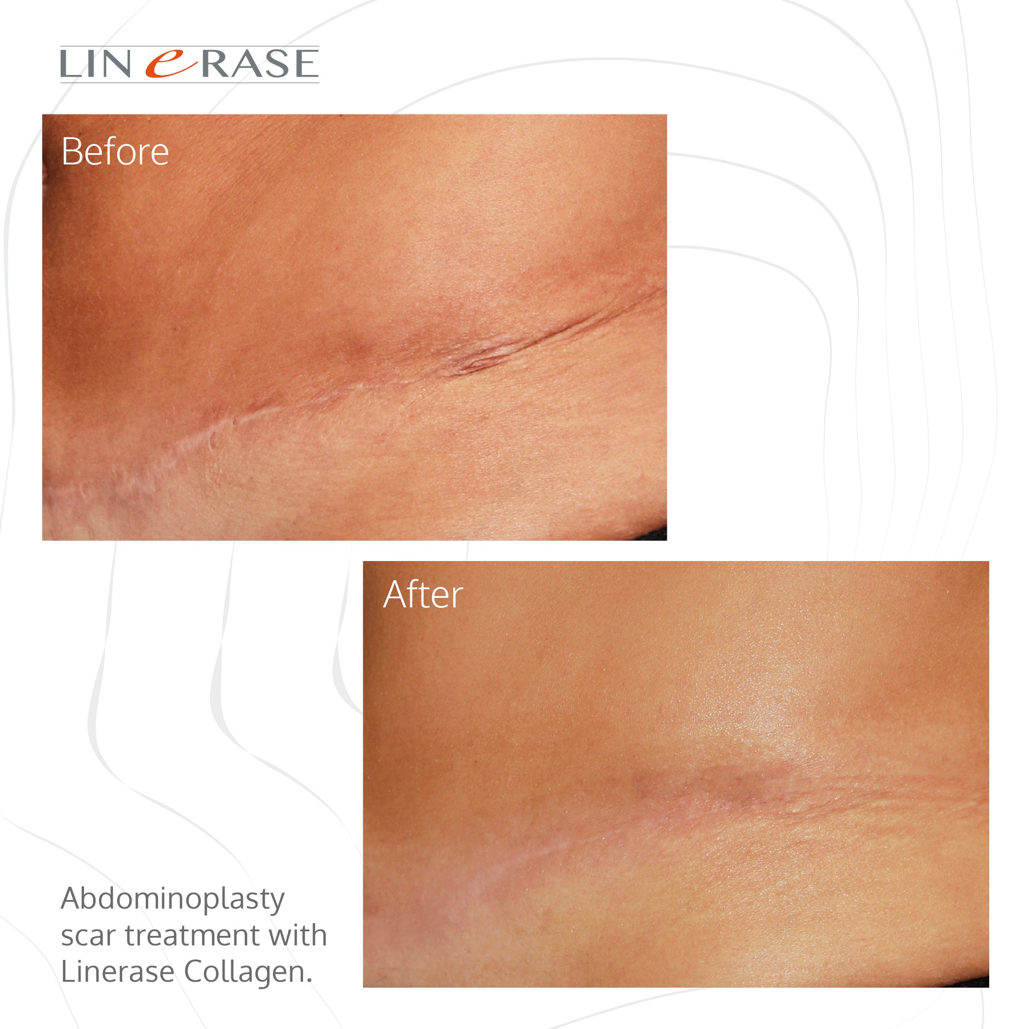 linerase