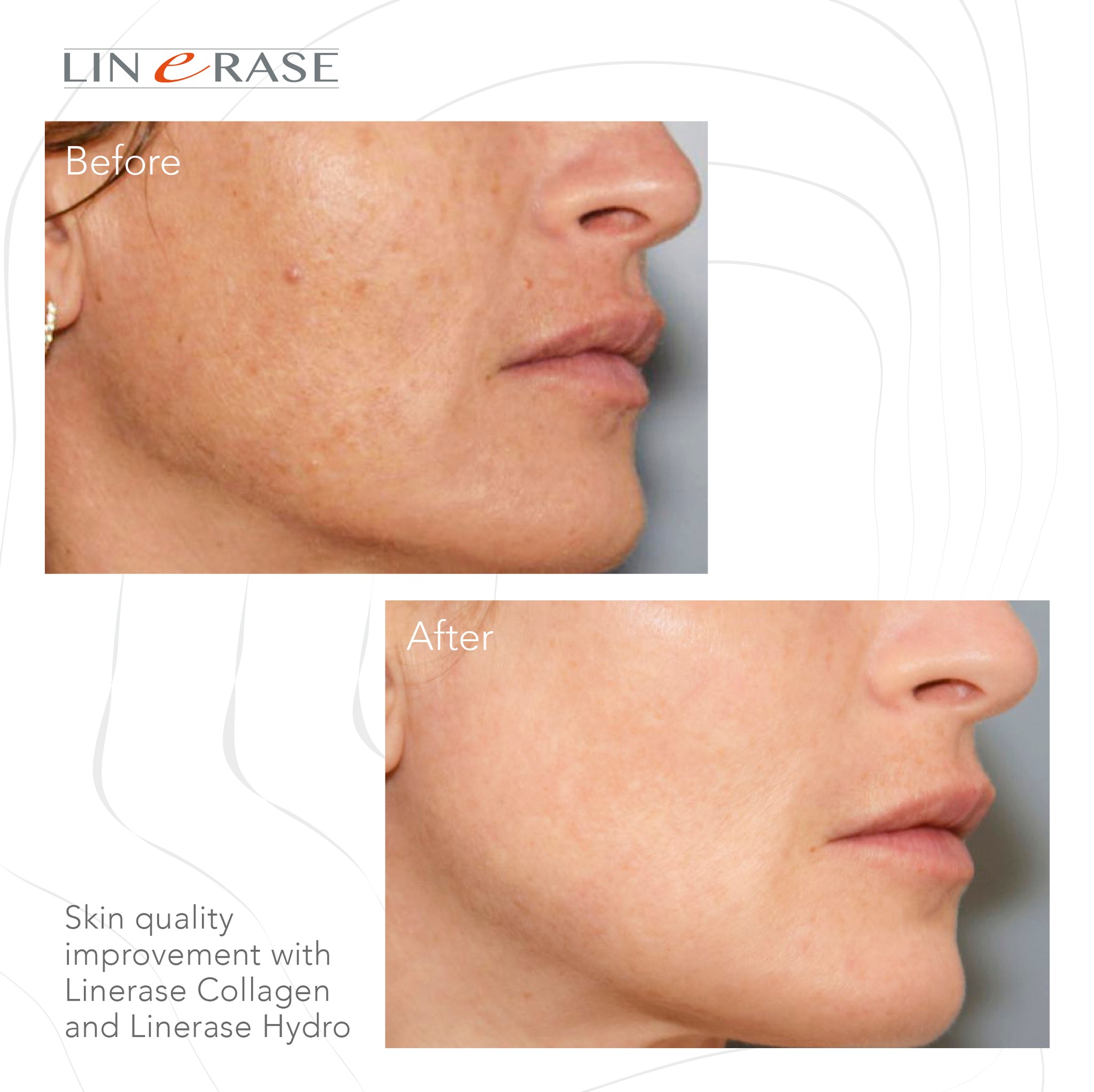 linerase