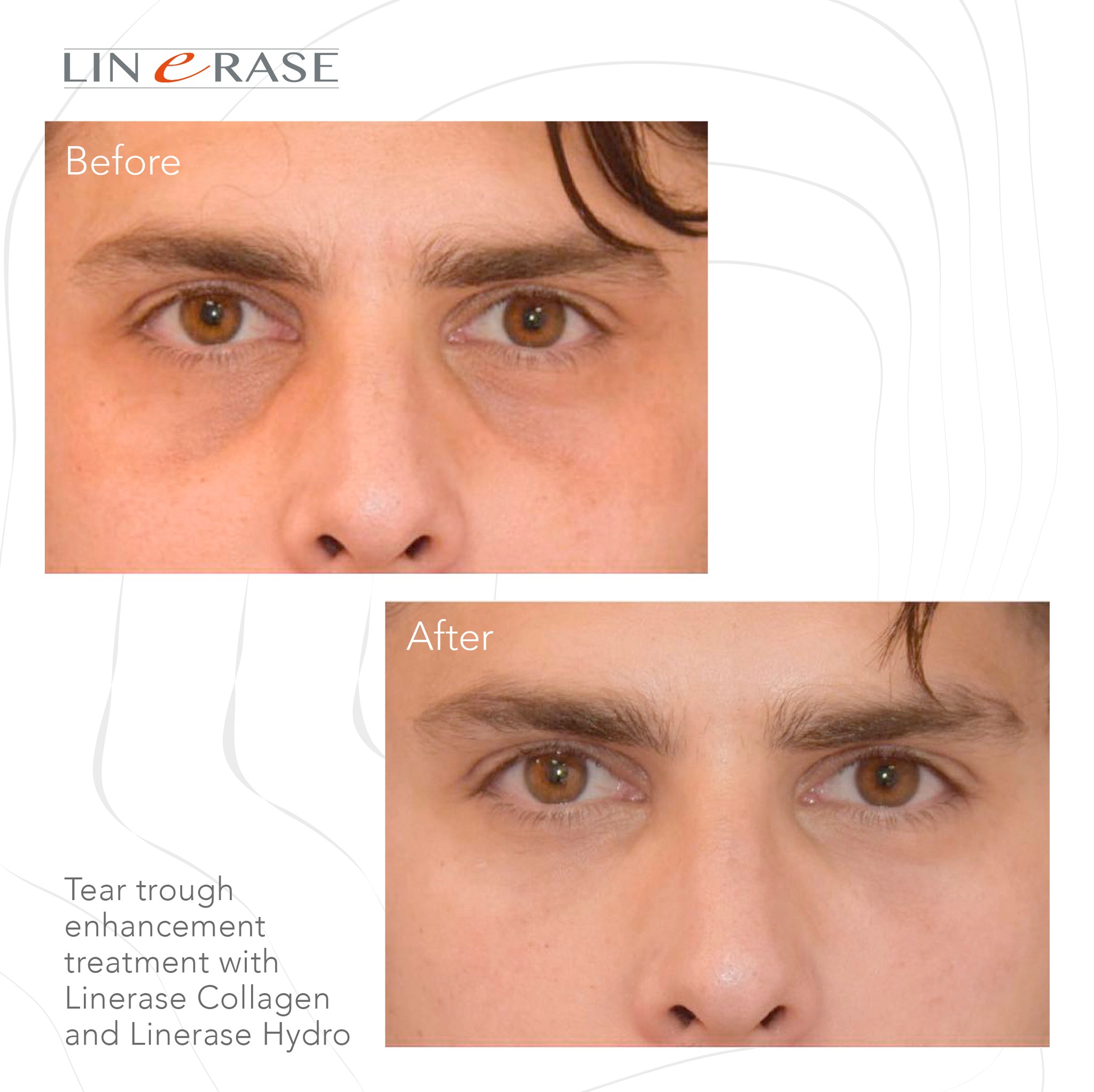linerase