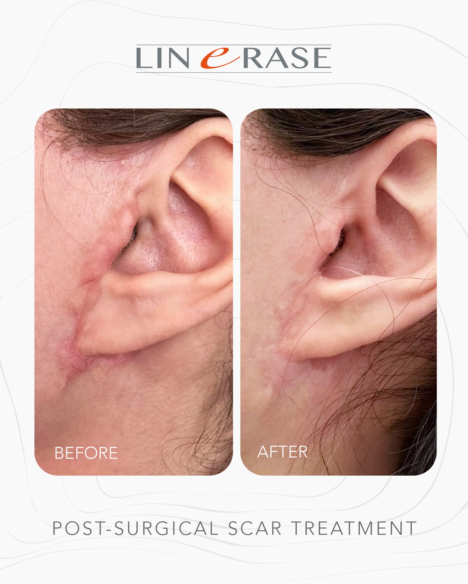 linerase