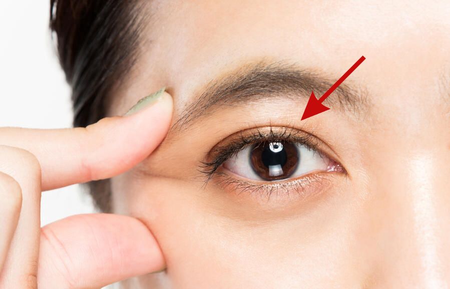 double eyelid suture