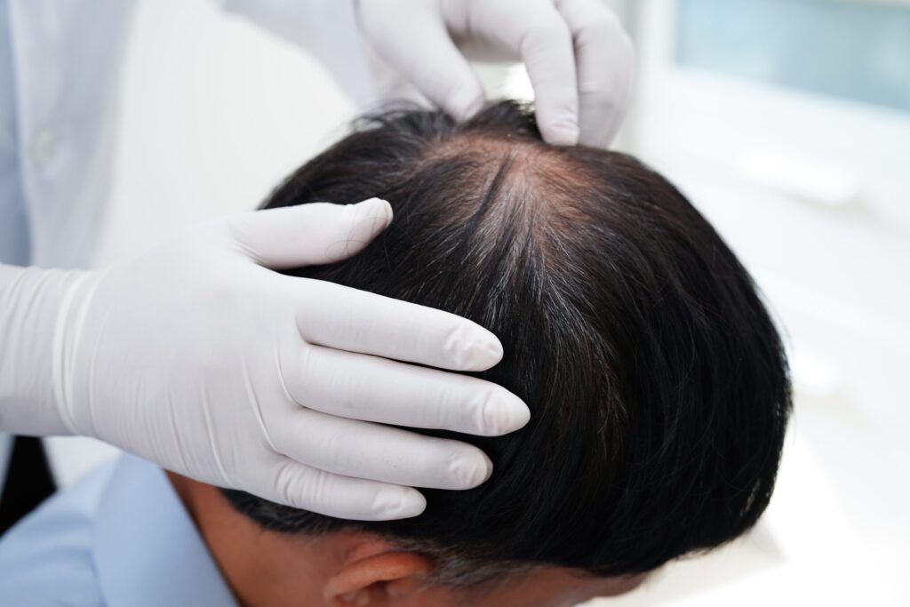 hair loss