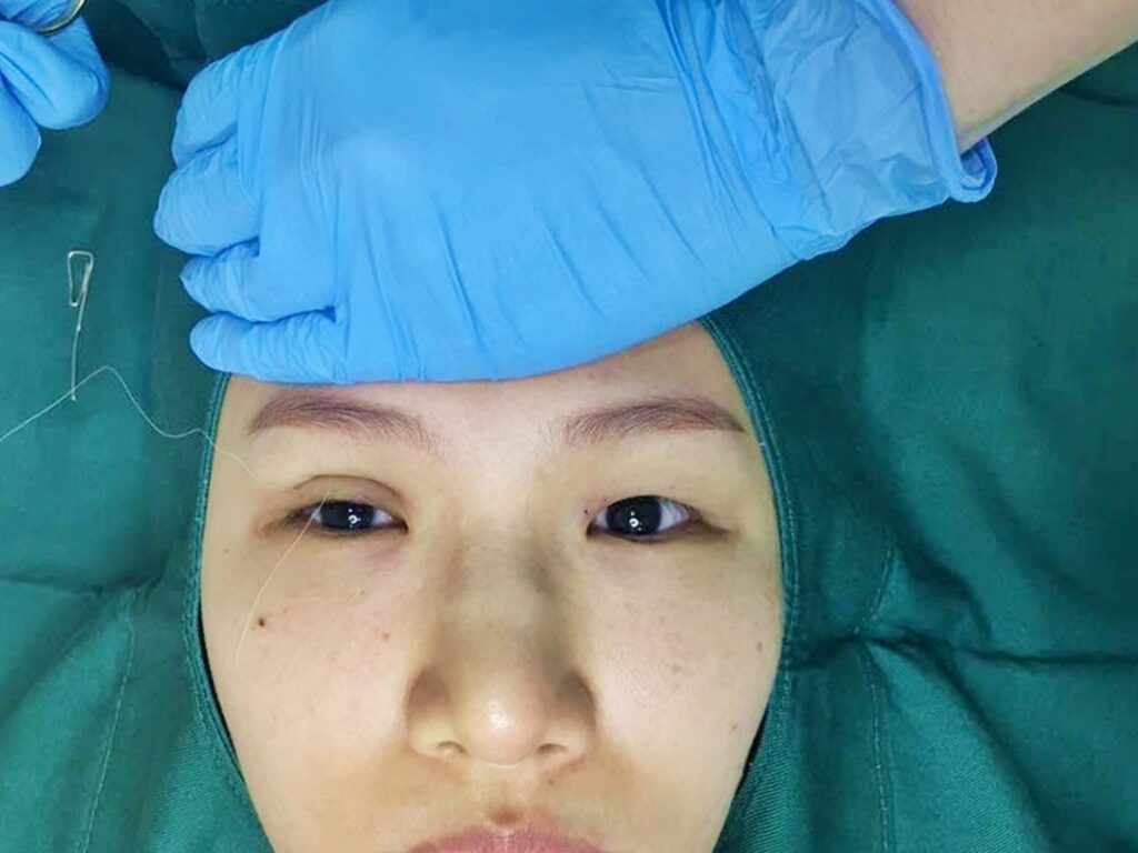 double eyelid suture