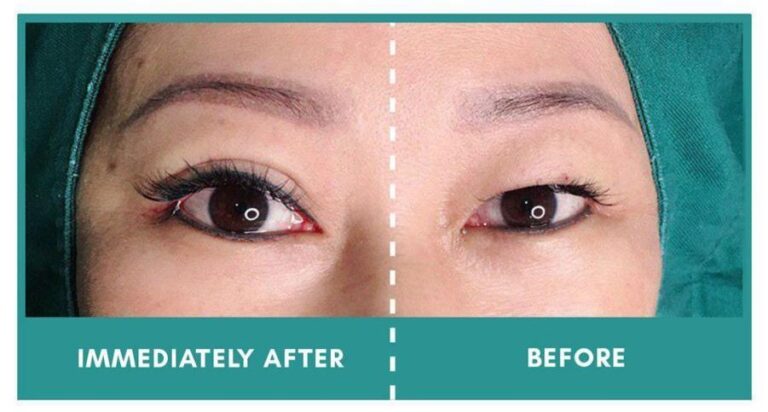 double eyelid suture