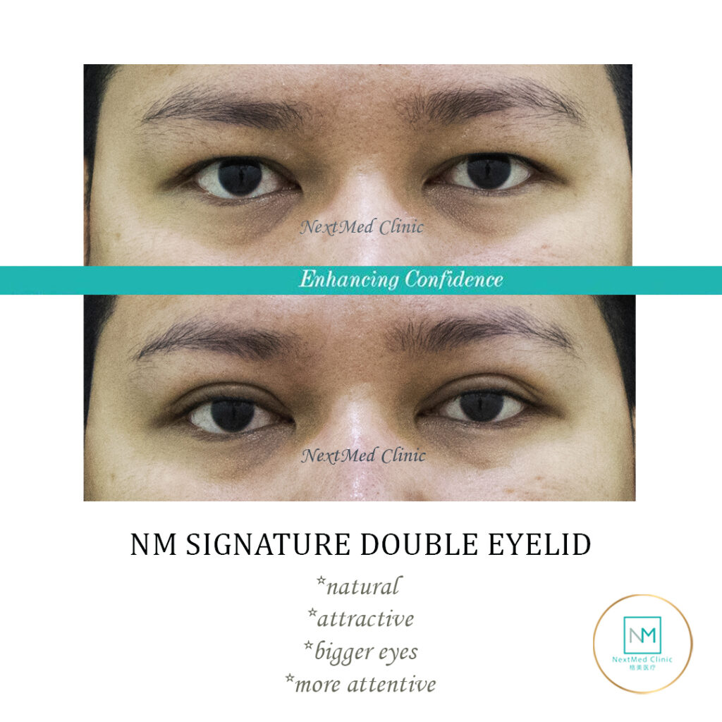 before after NM DST 12