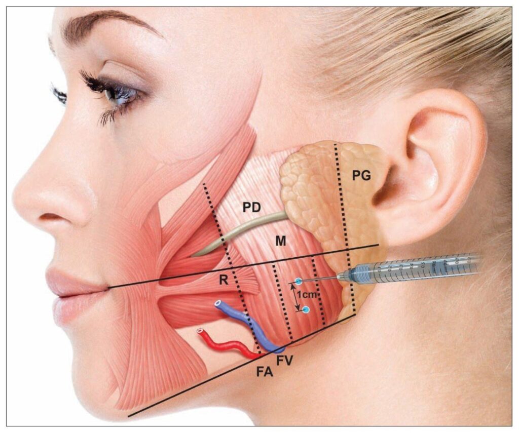 Botox treatment for teeth grinding bruxism