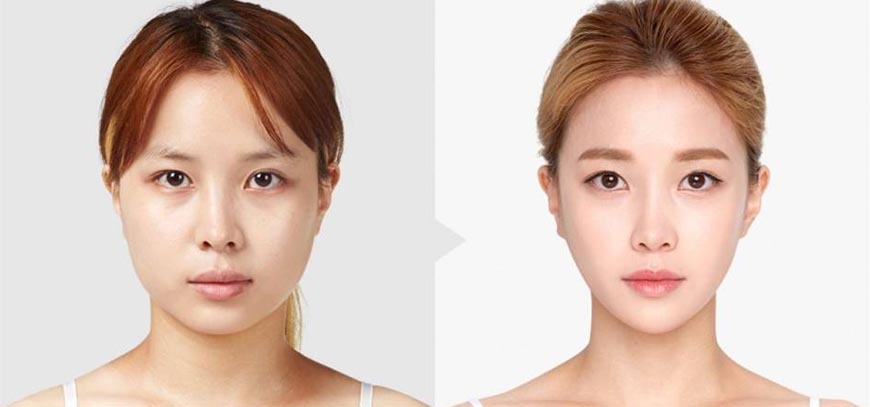 Masseter Botox before and after jaw reduction