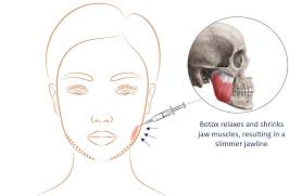 Masseter Botox jaw slimming treatment in Malaysia