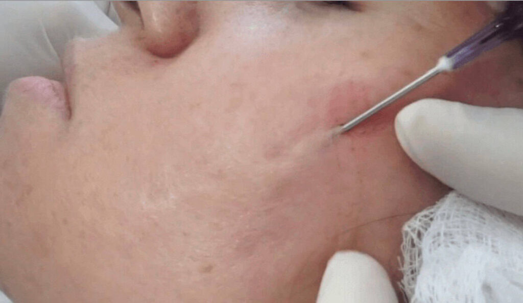 acne scar treatment in Kuala Lumpur