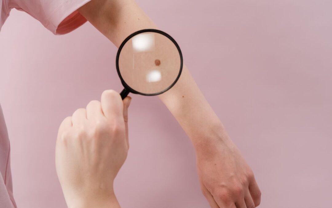 Magnifying glass held over a small brown spot on an arm