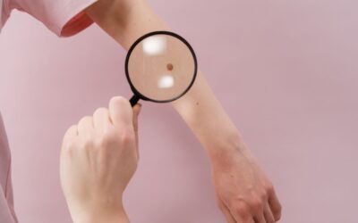 A Dark Spot Is Changing: When to Seek Medical Assessment Before Cosmetic Treatment